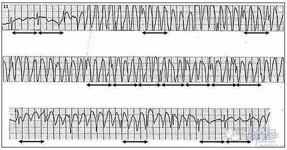这些危及生命的心电图必须认识!