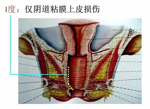 医学笔记|会阴撕裂伤的分类,看这几张图就够了