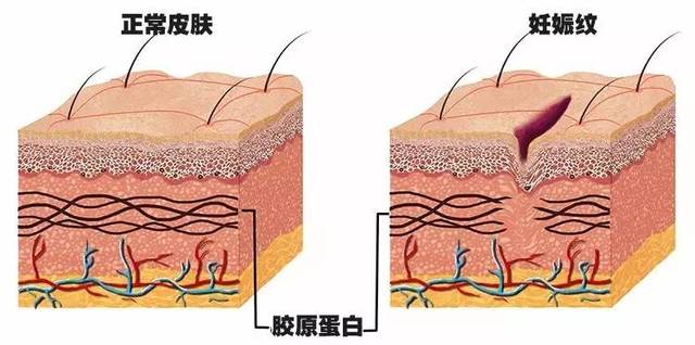 妊娠纹看着差不多,但本质不一样,肥胖纹一般出现在脂肪堆积较多的位置