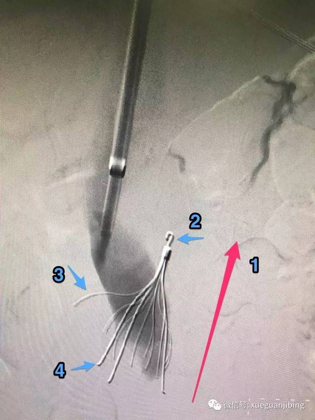 celect 腔静脉滤器取出1例