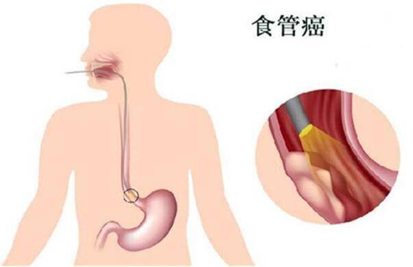 食管癌