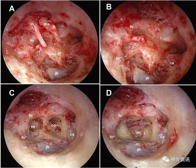 内镜下经外耳道-鼓岬入路切除听神经瘤