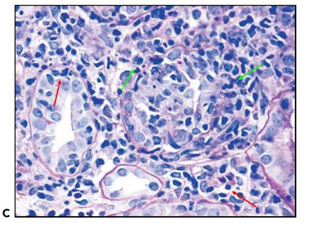肾内病理图解:小管间质性肾炎