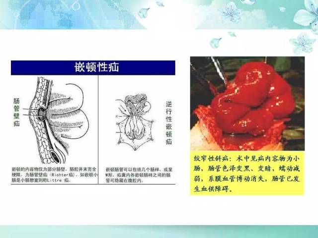 腹外疝病人的护理