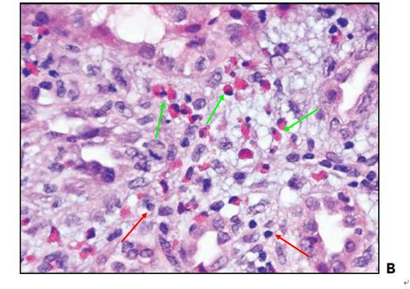 he染色:红色箭头:肾间质淋巴或浆细胞浸润;绿色箭头:肾间质嗜酸性