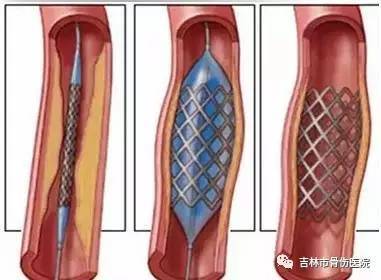 心脏支架