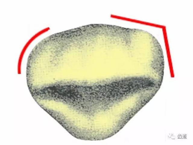 一颗牙的解剖上颌中切牙解剖形态特征