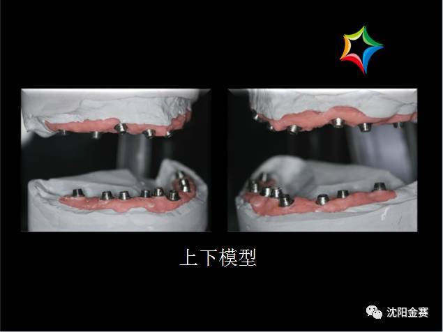 全口无牙颌种植——螺丝固位桥架修复病例