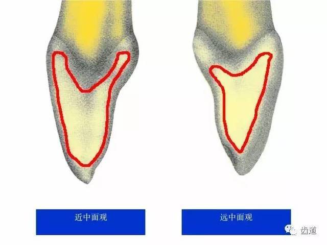 一颗牙的解剖上颌中切牙解剖形态特征