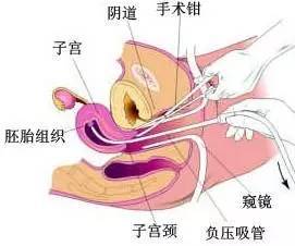 女人"刮宫"术,感觉就像全身被掏空