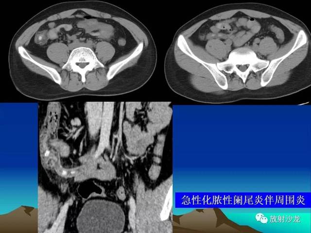 开课了 急性阑尾炎的ct诊断及鉴别诊断