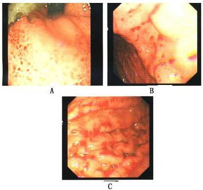 a:胃底粘膜典型马赛克征,在充血水肿粘膜出现黄白网状间隔 b,c:胃黏膜