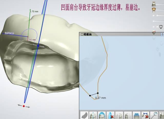 影响全瓷牙冠裂的因素有哪些?