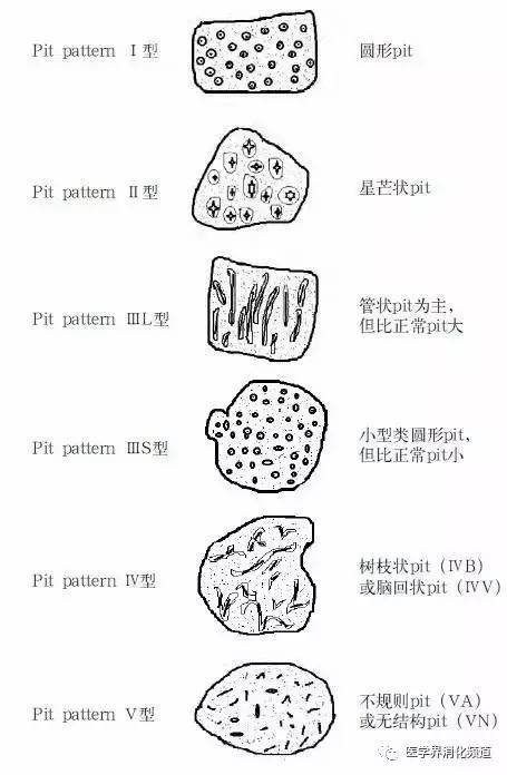 pit pattern分型示意图