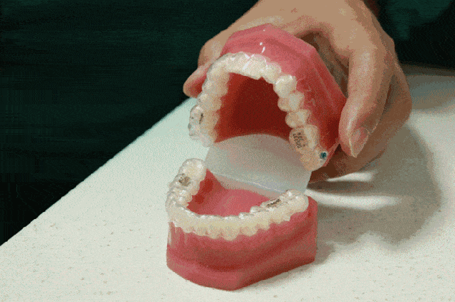 透明牙套:有史以来最成功的牙齿矫正产品之一