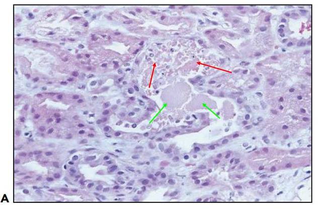 肾内病理图解:缺血性和毒性急性肾小管损伤