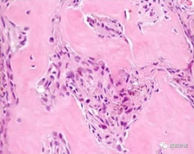 tumor of hyperparathyroidism) 【术后病理】 甲状旁腺功能亢进棕色