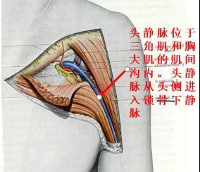 头静脉入路: 1.1 传统头静脉切开术[3,4] 在锁骨中点下方1.