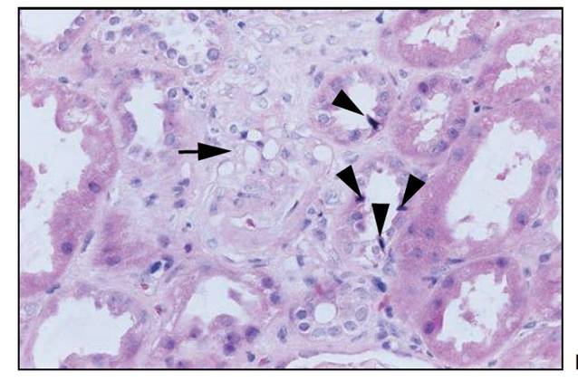 肾内病理图解:缺血性和毒性急性肾小管损伤