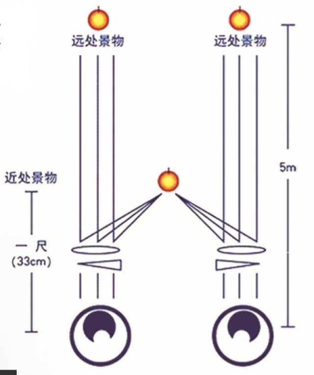 中华眼科泰斗——徐广第先生提出的"附加基底向内三棱镜的低度凸透镜