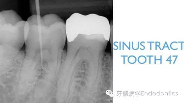 图3.牙胶尖示踪窦道达47根分叉