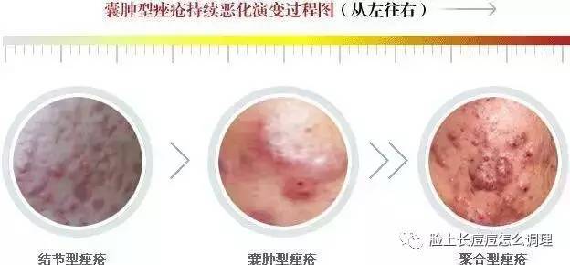 白头粉刺是如何一步步恶化,转变为"结节型" "囊肿型"痤疮