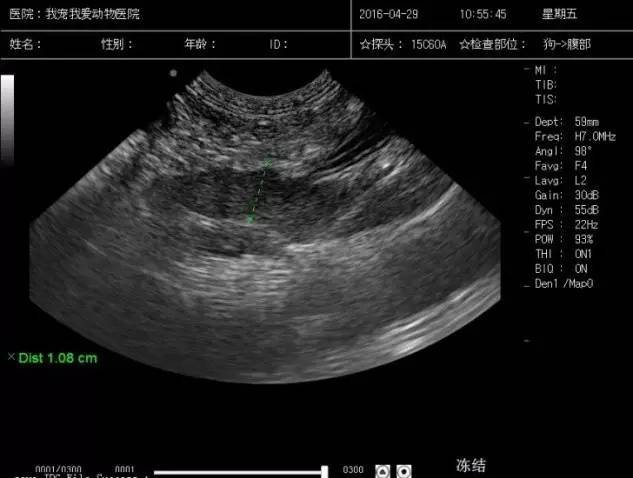 急性胰腺炎- 肿大 胰体多会大于0.