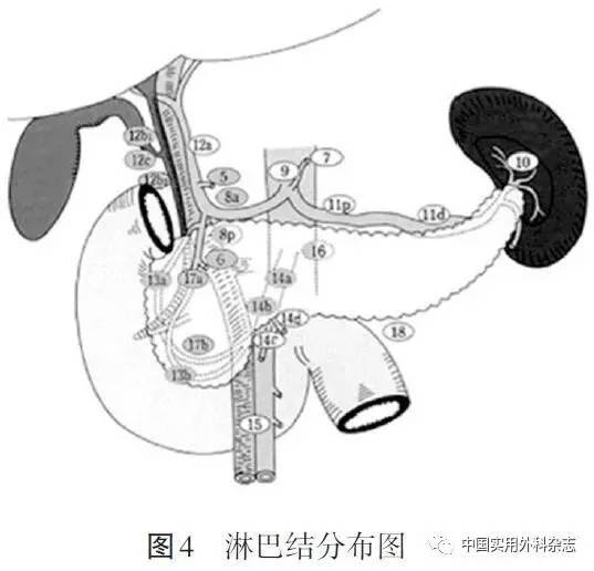 国际外科动态∣美国癌症联合委员会壶腹部癌分期系统