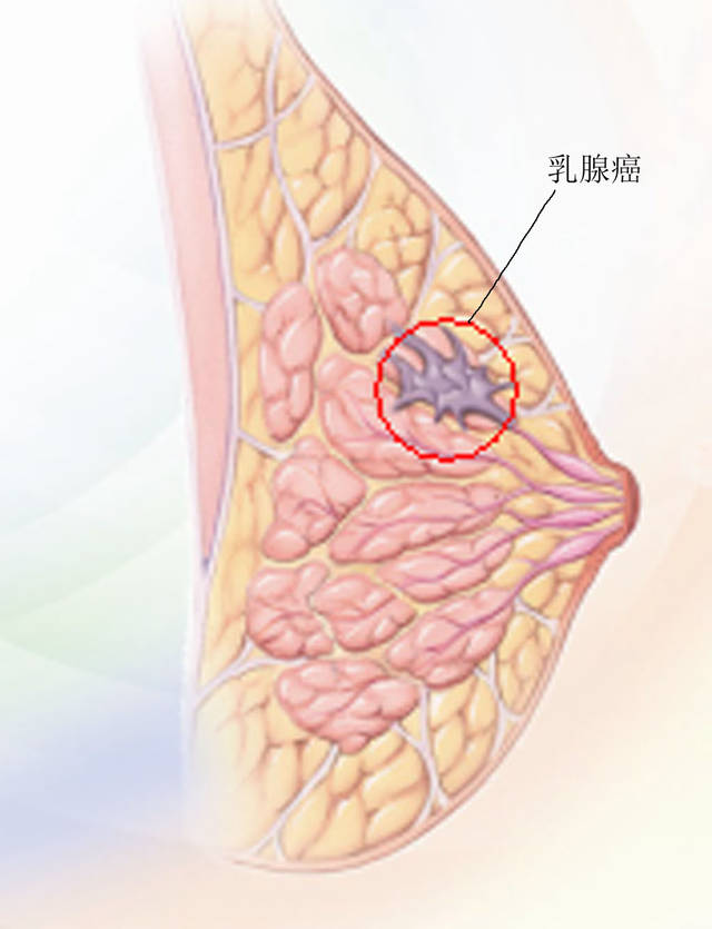 警惕乳腺癌早期症状