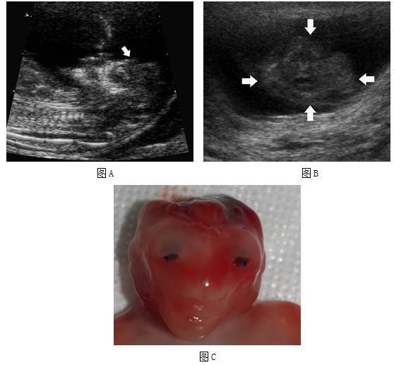 胎儿严重结构畸形的产前筛查与诊断:从中孕期提前到早孕期