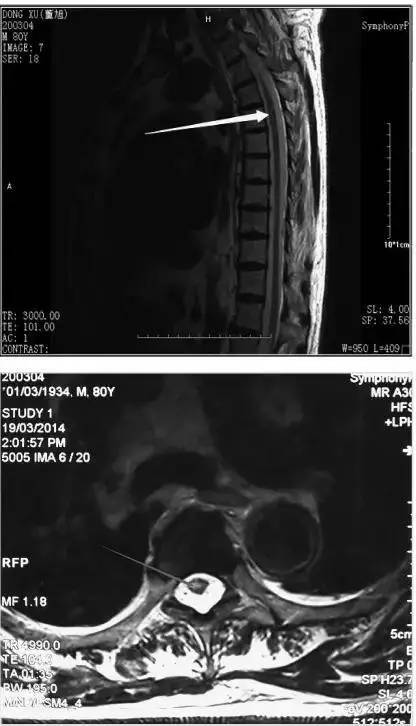 胸4～5脊髓薄层扫描示:考虑胸7椎体血管瘤,胸10/11水平黄韧带稍肥厚