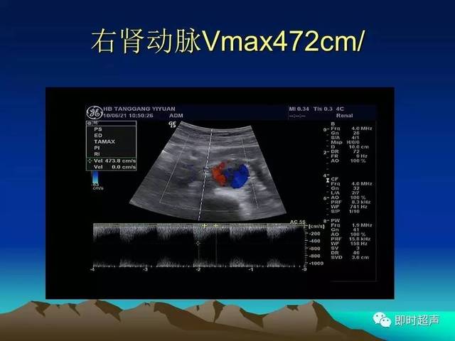 为转载,版权归原作者所有,转载仅作分享,文章观点不作为即时超声观点