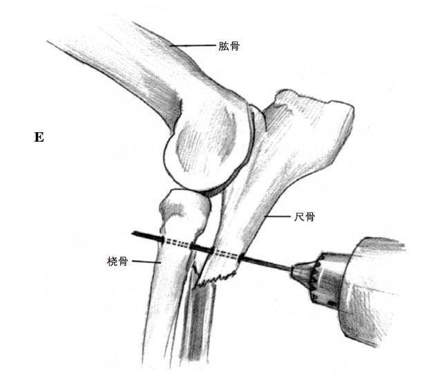 g将桡骨头复位,然后选择合适尺寸的施氏针,先将其穿过鹰嘴突,打入近