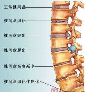 辟谣!桑枝并不能治疗腰椎间盘突出和颈椎病