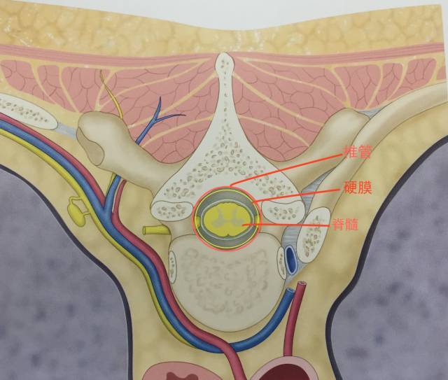 腰腿疼居然是因椎管内长肿瘤?手术全程是这样的.