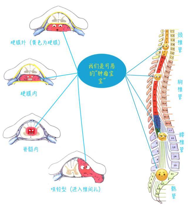 椎管内肿瘤可以生长在椎管的任何一个位置,根据在椎管内生长的层次,又