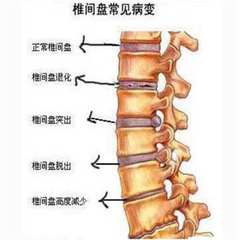 惊奇!腰椎间盘突出原来还可以这样治疗