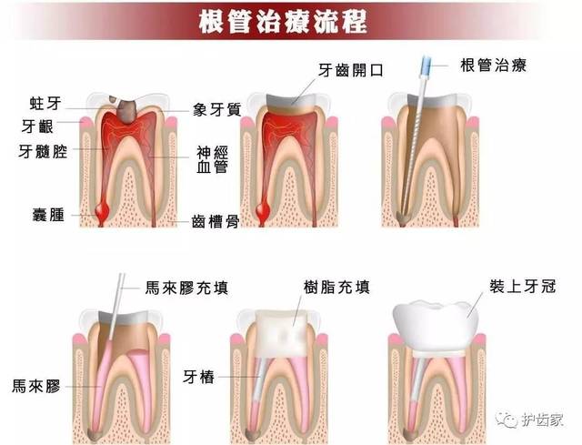 做牙套是为了延长根管治疗后牙齿的使用寿命,那牙齿的使用时长还跟