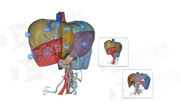 三维影像,患者的肝肿瘤,肝段,肝脏内部复杂的管道解剖结构都以直观