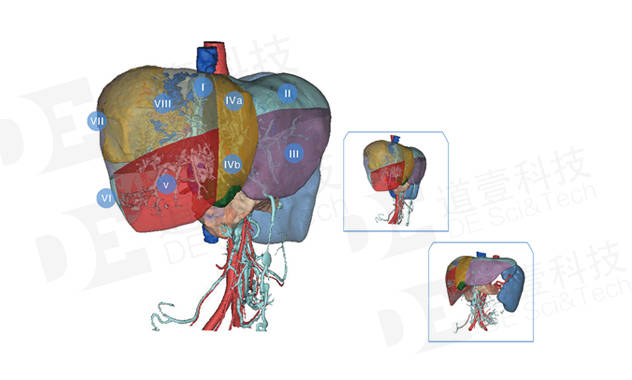 广西民族医院利用道壹科技肝脏三维重建成功实施肝