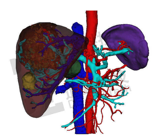 通过道壹科技医学三维重建,清晰的解剖肝内血管,实时引导重要管道的