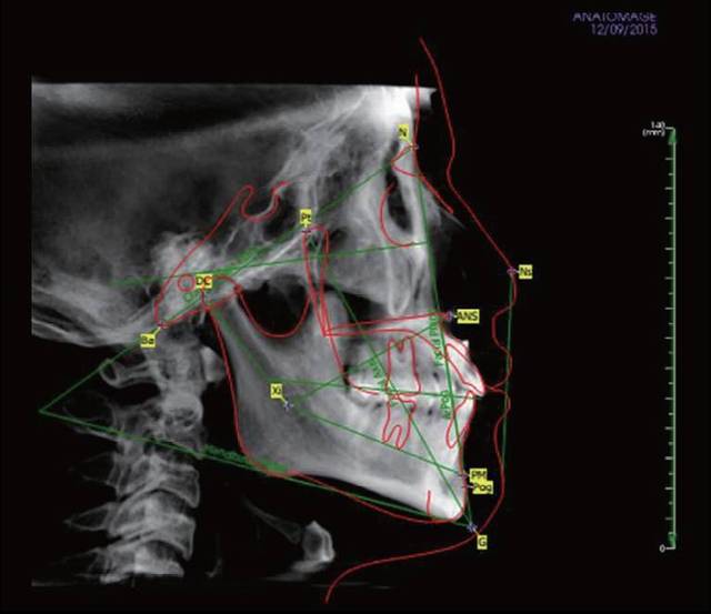 患者治疗前头颅侧位片检查情况 口腔锥形束ct(cbct)示双侧髁突有