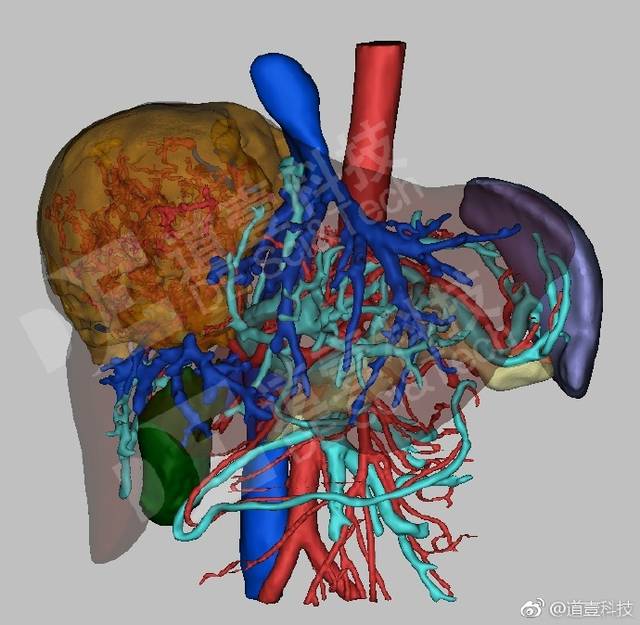 道壹科技的医学三维重建,可以全方位立体观察评估病灶与肝脏内部血管