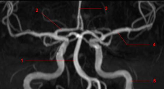 大脑willis环的解剖及变异