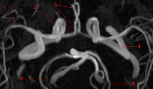 大脑willis环的解剖及变异