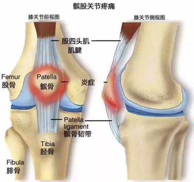 导致慢性的关节损伤,更严重地,会使髌骨股骨间的软骨受损而演变成髌骨