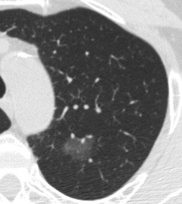 低剂量CT,肺癌早期筛查第一选择