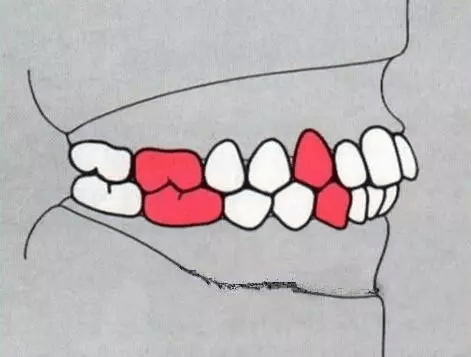 正常牙齿排列是这个样子,看看你的是否正常?