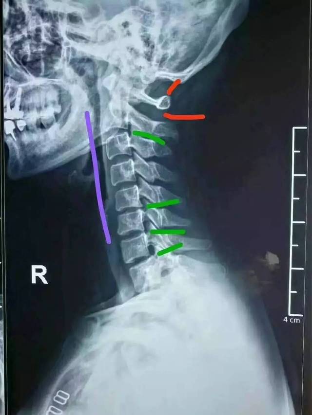 草莓x光证实颈椎失稳