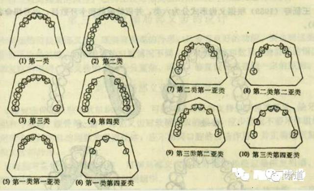 可摘局部义齿的肯氏(kennedy)分类及设计